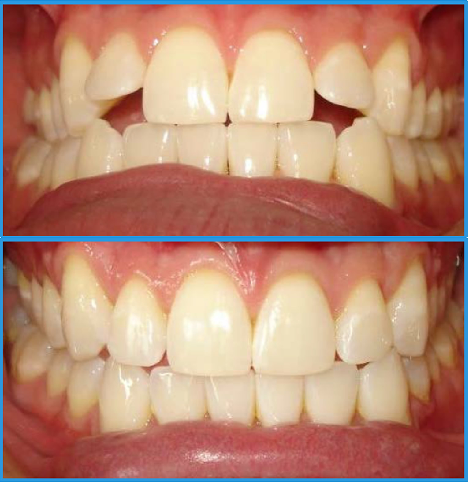 alignersbeforeafter Dental Associates of Connecticut